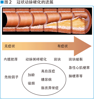 图2 冠状动脉硬化的进展