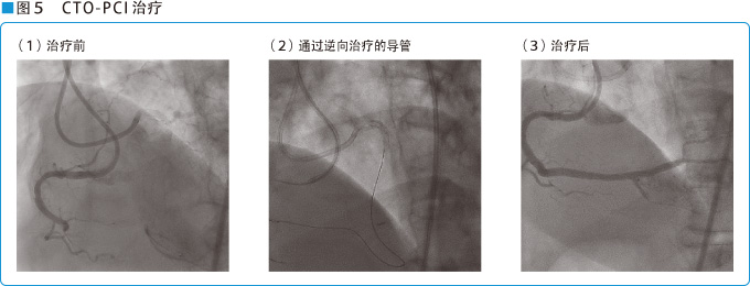 图5 CTO-PCI治疗