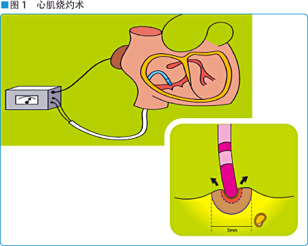 图1 心肌烧灼术