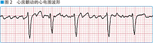 图2 心房顫动的心电图波形