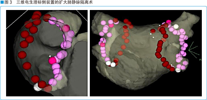 图3 三维电生理标侧装置的扩大肺静脉隔离术