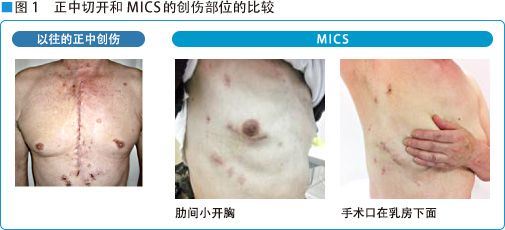 图1 正中切开和MICS的创伤部位的比较