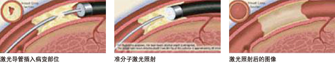 准分子激光冠状动脉成形术 ELCA