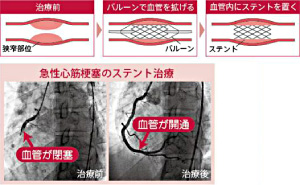 冠状动脉支架治疗 PCI