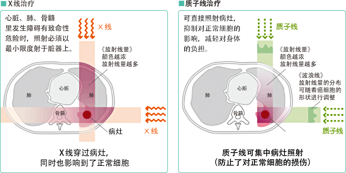 X线治疗同质子线治疗的线量分布图比较