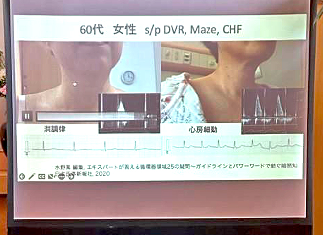 60岁女性心电图的症例分析